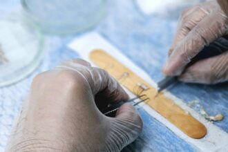 Résultats naturels d'une greffe de barbe sans cicatrices visibles